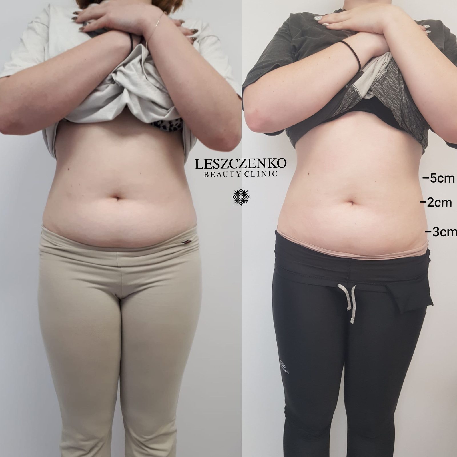 Body contouring